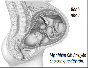 CYTOMEGALOVIRUS CYTOMEGALOVIRUS